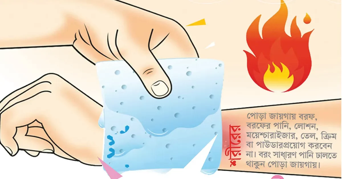 শিশুদের শরীর পুড়ে গেলে জরুরি করণীয়: দ্রুত পদক্ষেপেই বাঁচতে পারে একটি জীবন